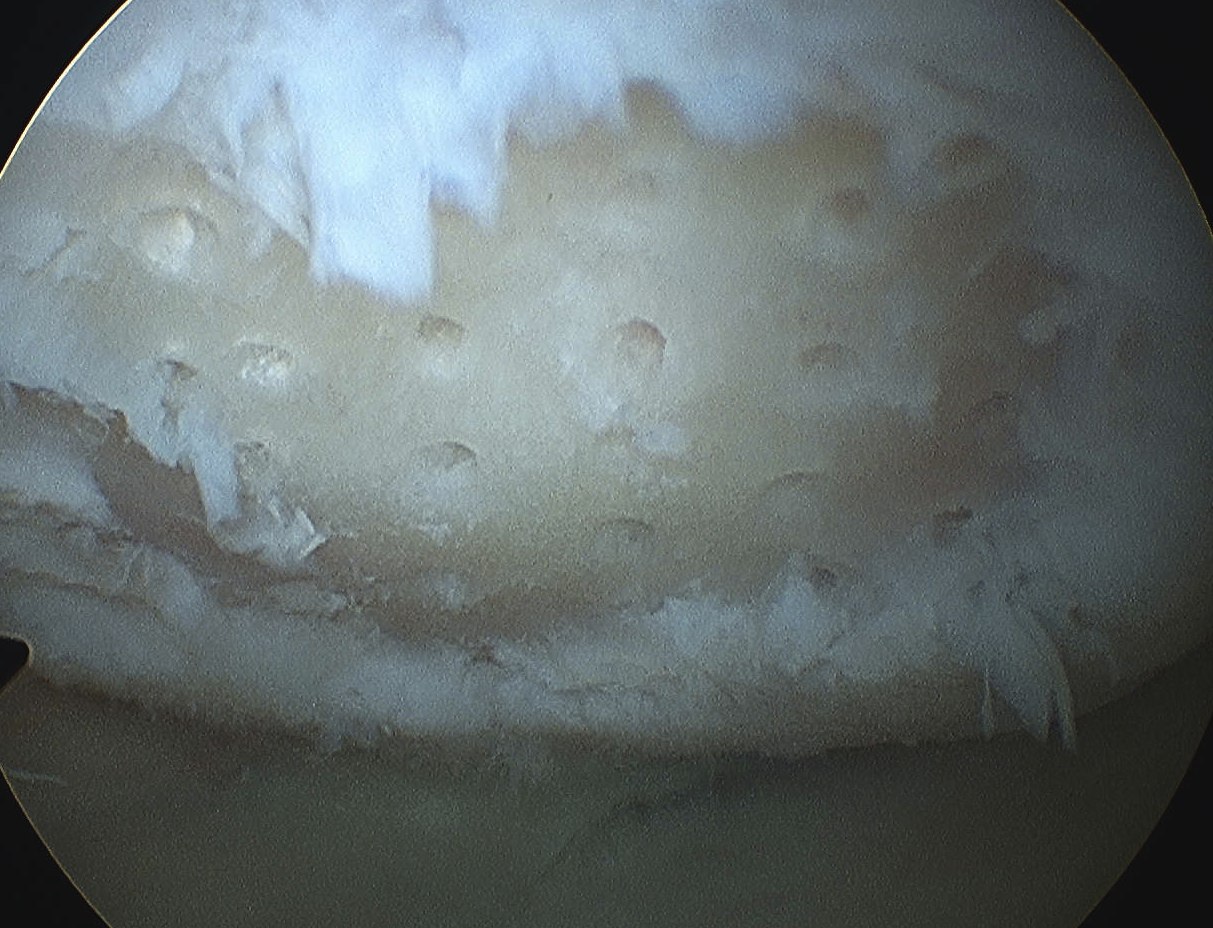 Microfracture Awl Holes Pre Suction
